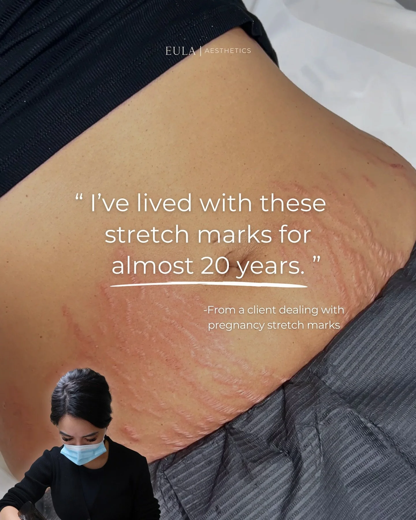 Helping a mother of two soften her pregnancy stretch marks reminded me why I love doing what I do 🤍 it&rsquo;s work that restores my clients&rsquo; skin and their confidence. 

You can do the same after my Stretch Mark Revision Training.
Read more a