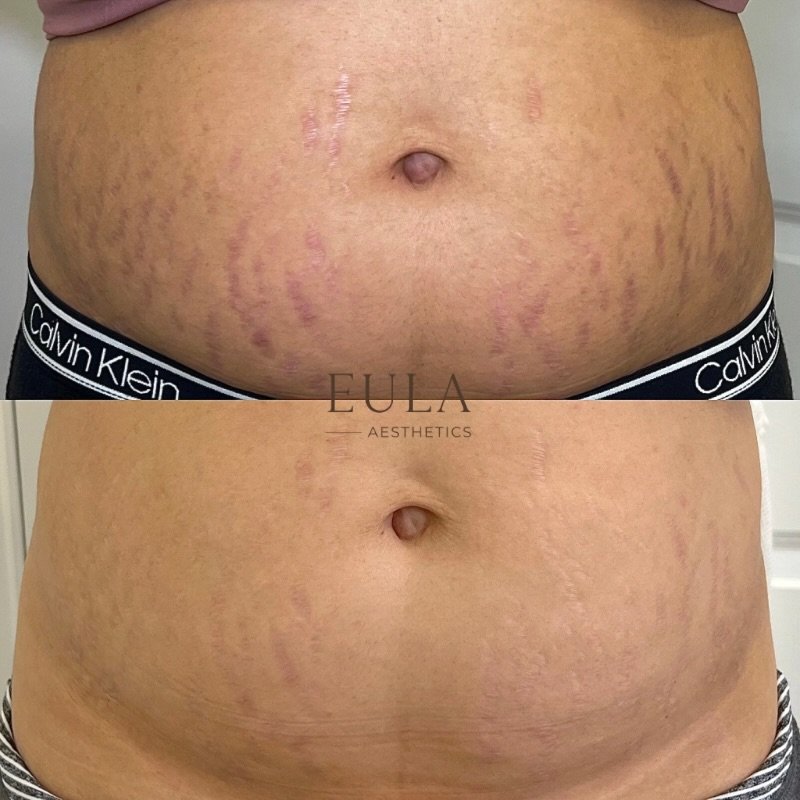 After 2/3 sessions of inkless stretch mark revision 🖊️

Inkless stretch mark revision is an advanced skin treatment designed to help improve the appearance and texture of stretch marks and scars by creating controlled, precise trauma within the skin