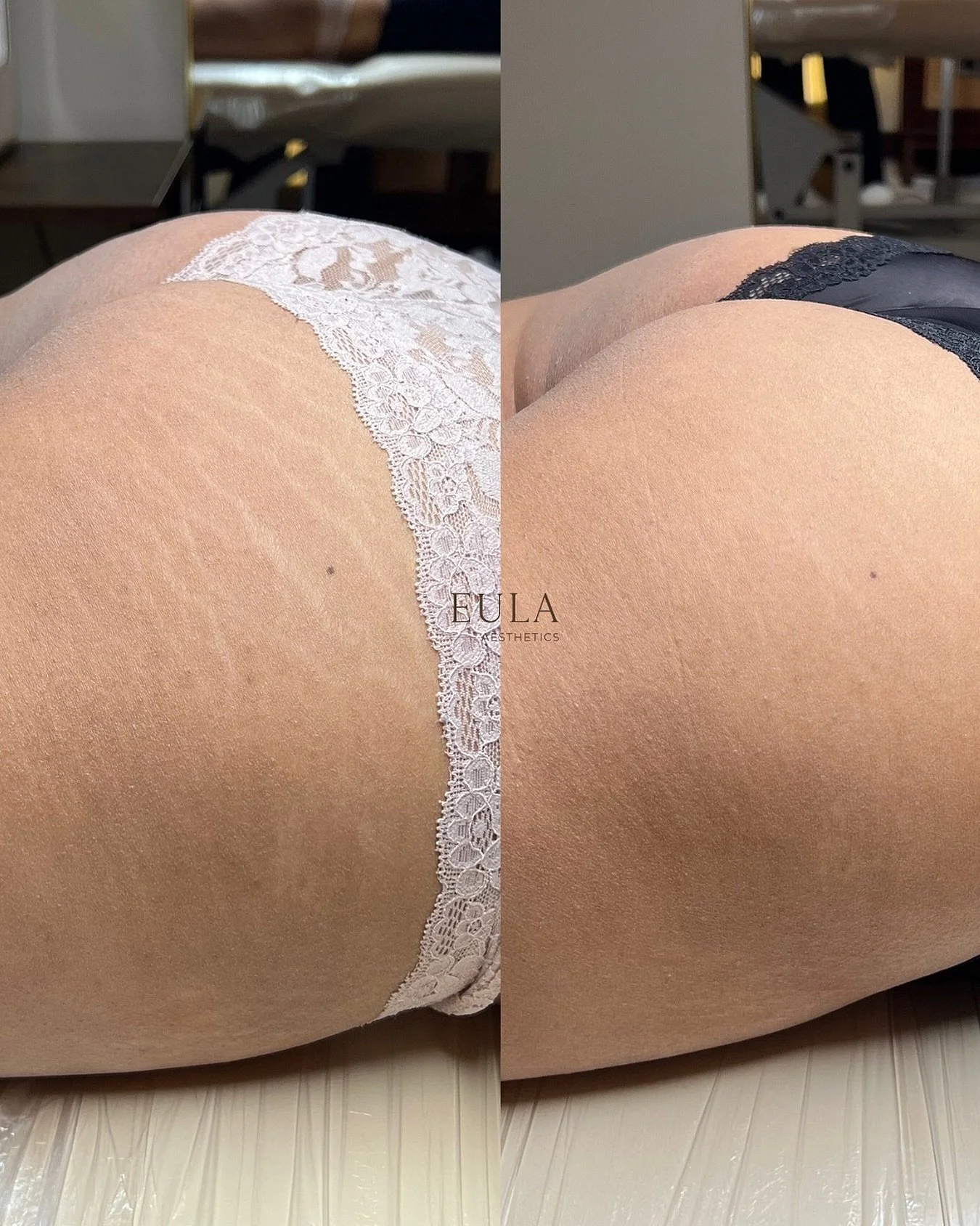 Inkless stretch mark revision 

A non-invasive treatment designed to help improve the appearance, texture, and overall look of stretch marks by stimulating your body&rsquo;s natural healing response and collagen production &mdash; without adding pigm