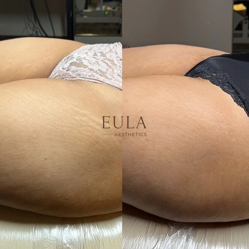 Stretch mark revision progress and this beautiful client of mine.

This client has completed her first session out of a recommended series of three. While results are still in progress, you can already notice an improvement in texture and a softer sm