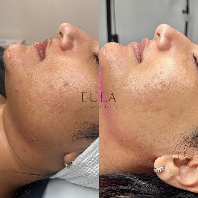 ✨ 3/4 Microneedling sessions

Progress takes time, and after 3 out of 4 microneedling sessions, we are already seeing a noticeable improvement in the appearance of the skin 🤍

This client&rsquo;s main concerns included the appearance of scarring, hy