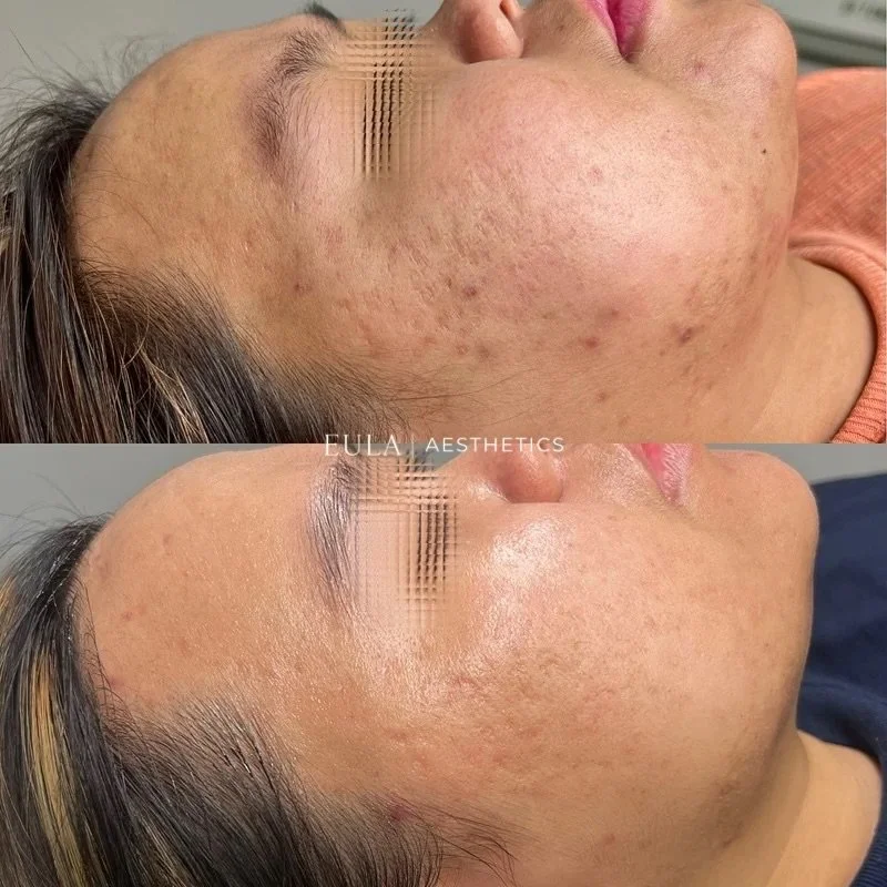 🖊️ 5/6 Microneedling session

One of the most common concerns my clients come to me with is the appearance of scarring, hyperpigmentation, uneven skin texture, and skin quality.

Microneedling is a minimally invasive treatment that creates controlle