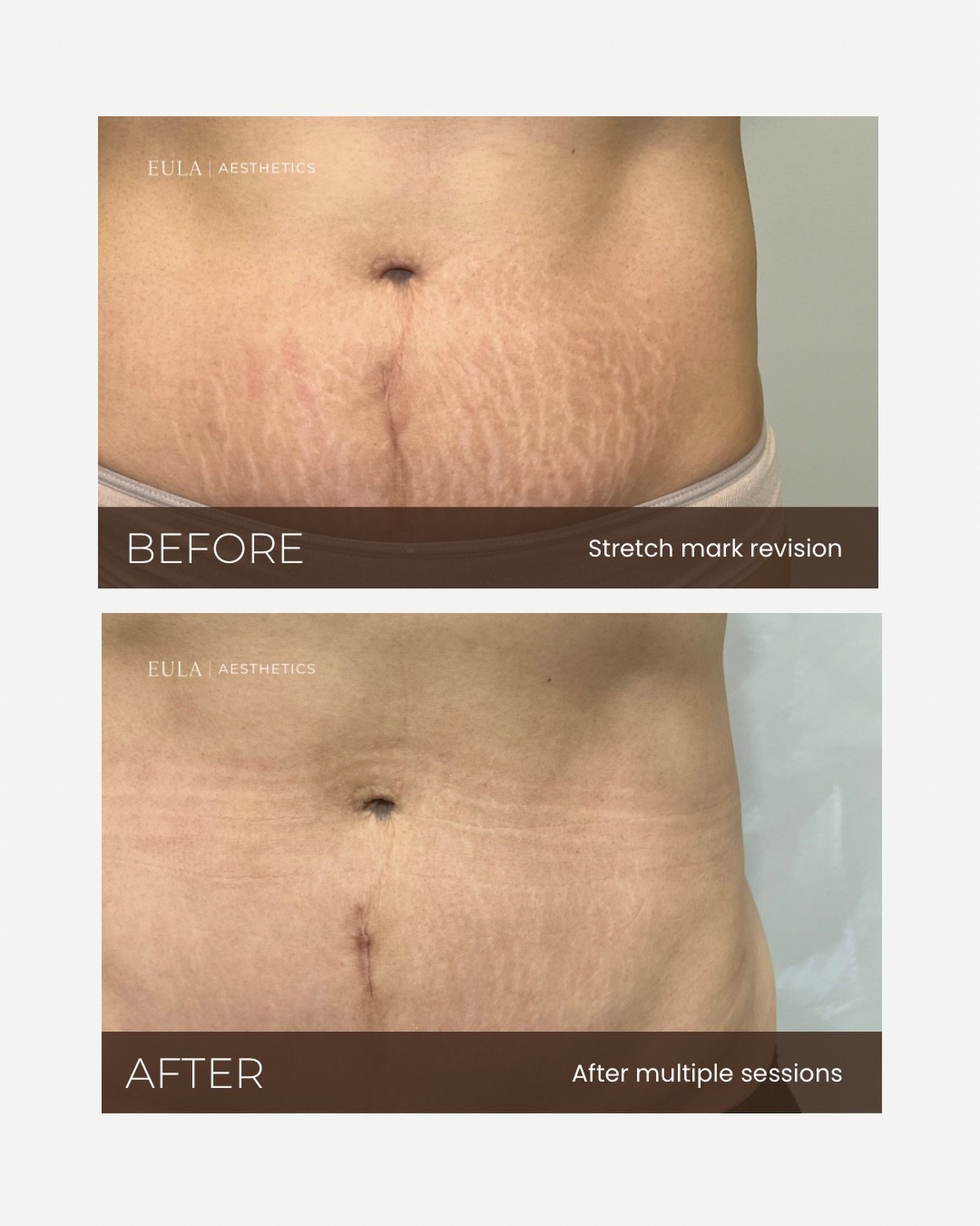 5/5 Stretch mark revision sessions 🖊️

This client has officially completed her 5-session stretch mark revision series on her stomach, and this is a great example of why stretch mark revision is a process &mdash; not a one-session treatment.

&bull;