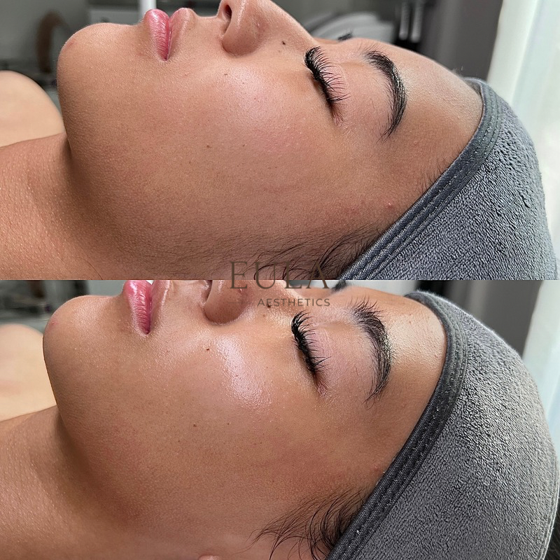 Comparison of a woman's face before and after a skincare treatment, showcasing smoother, more hydrated skin.