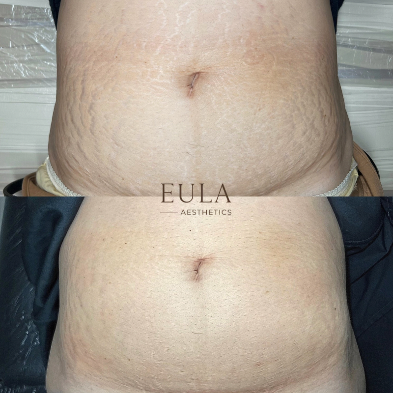 Less Textured Stretch Marks