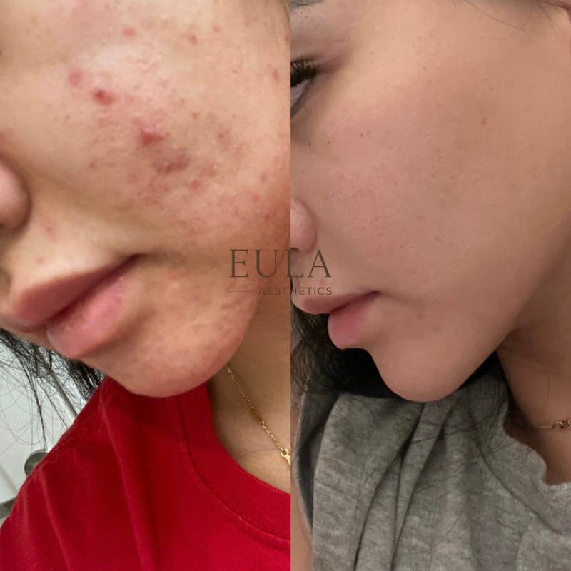 Before and after results of a Vancouver client following 4 chemical peel sessions at Eula Aesthetics, showing reduced redness, smoother texture, and visibly calmer skin.