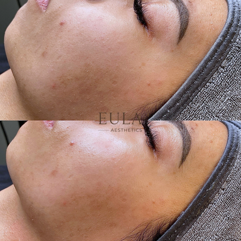 Comparison of a woman's face before and after a skincare treatment, showcasing clearer, more hydrated skin.