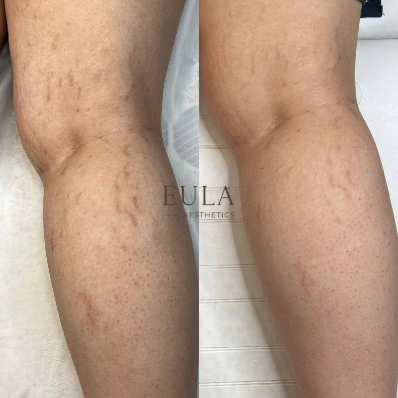 Hyperpigmentation