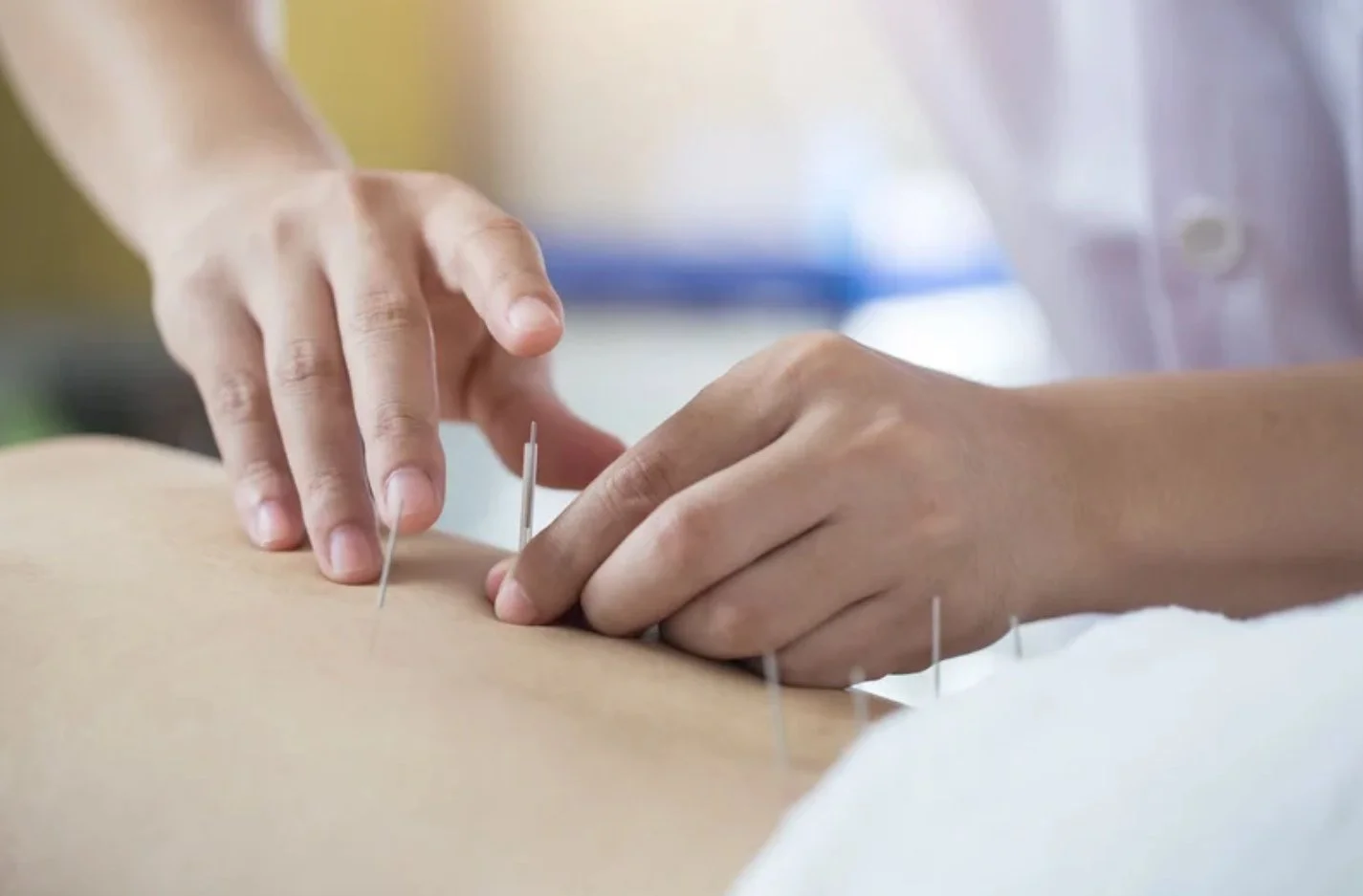 Acupuncture