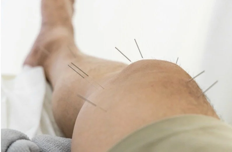 Acupuncture for Veterans in Colorado Springs