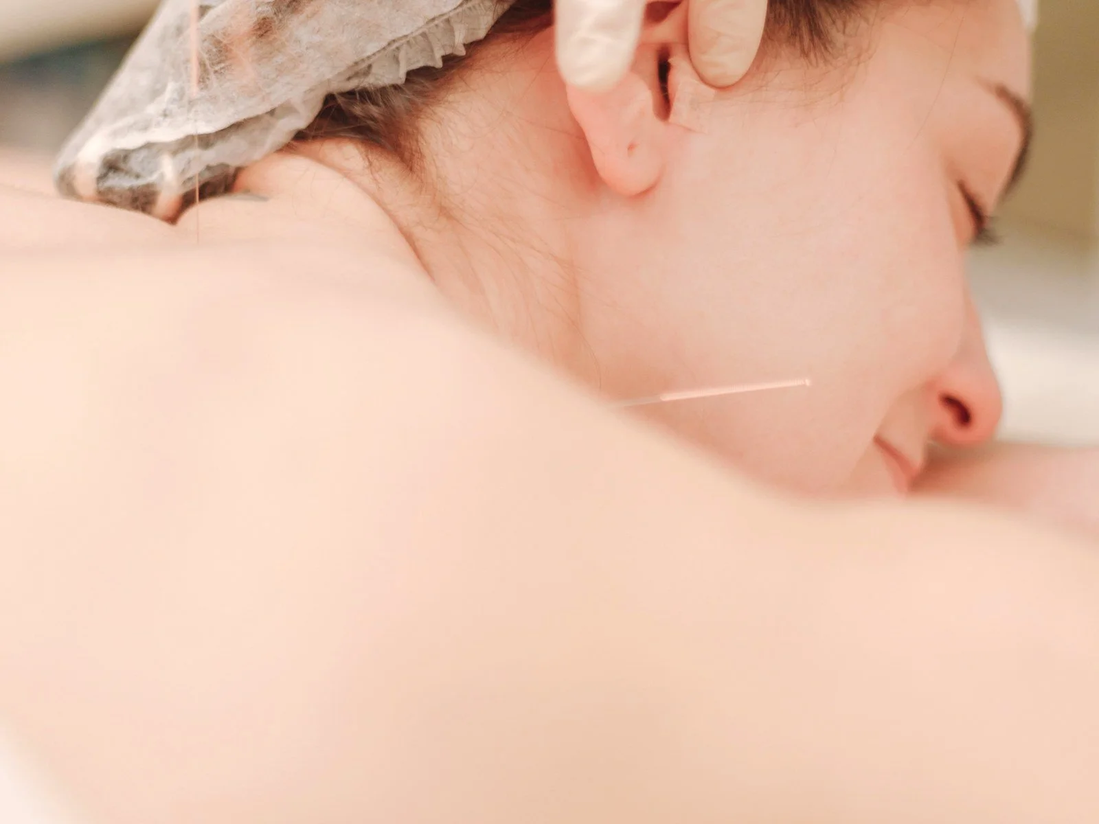 Woman resting calmly during an acupuncture treatment in Colorado Springs