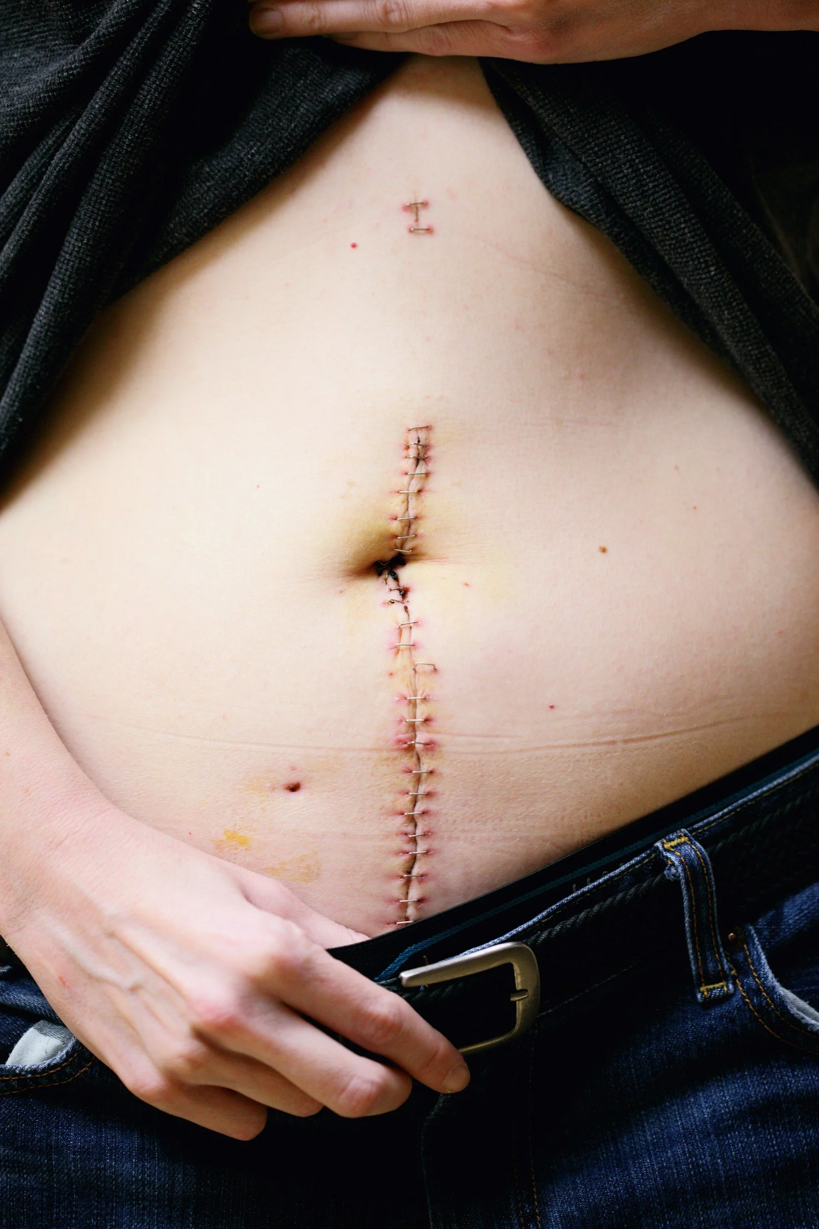 How C-Section Scar Tissue Can Affect Your Body Years Later
