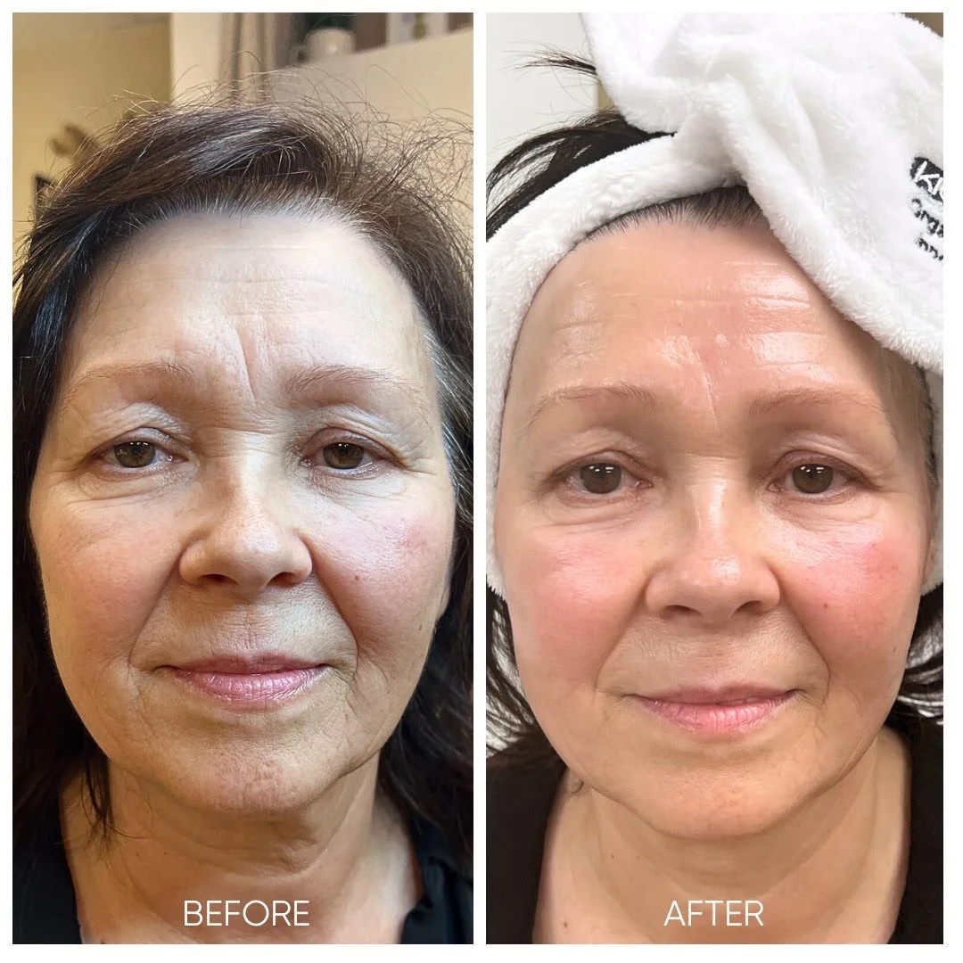 Sensitive Skin facial before and after of a client at Kiwi spa San Diego