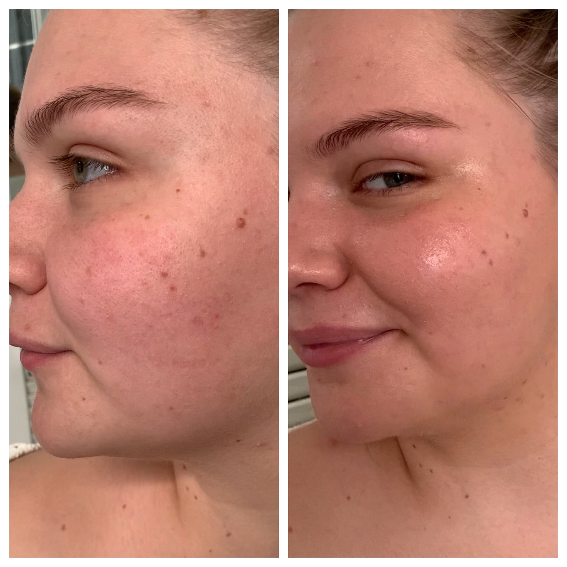 Before and after facial treatment showcasing improved skin texture and reduced wrinkles on an older person.