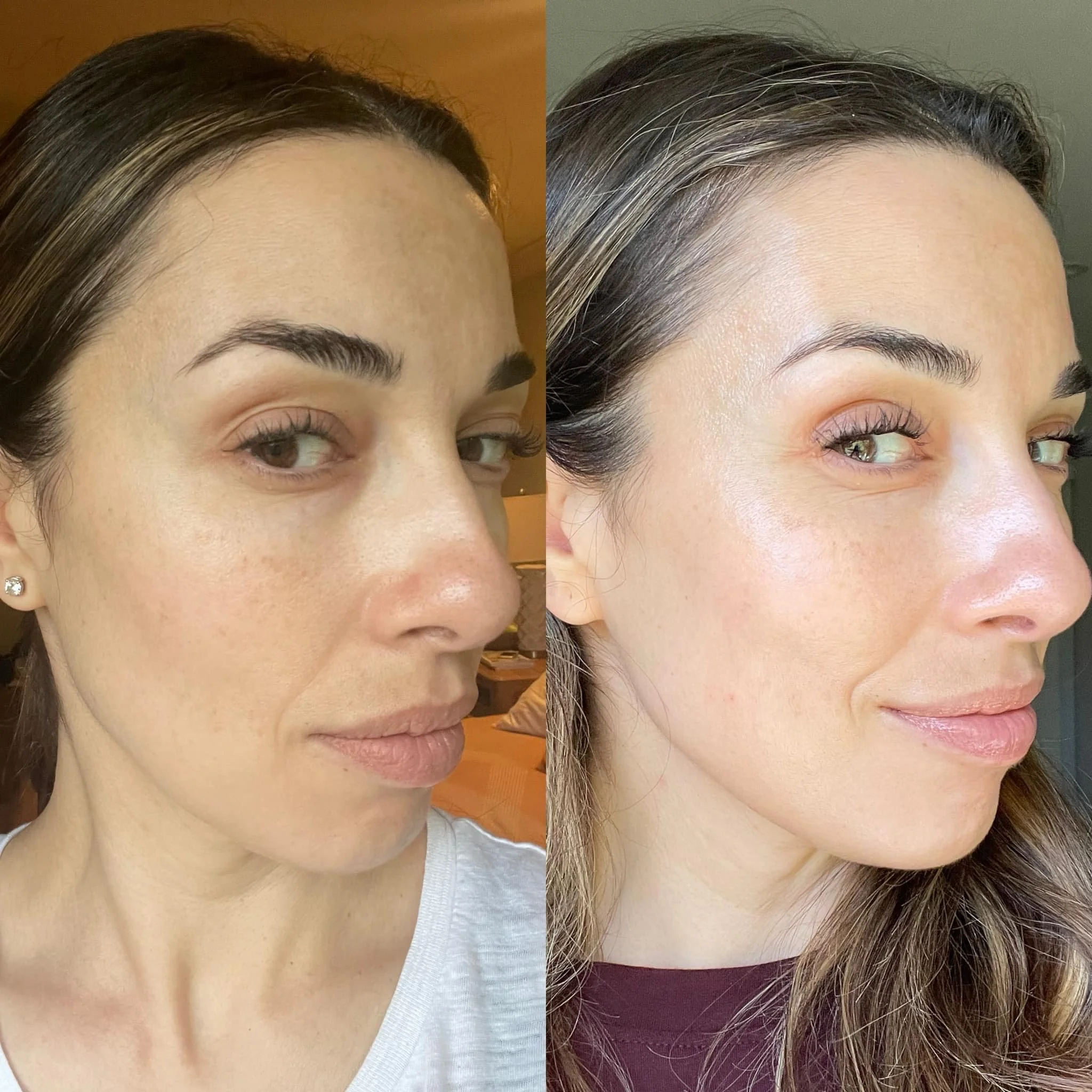 Side-by-side comparison of a woman's face before and after skincare, showing clearer skin and fewer blemishes in the after photo.