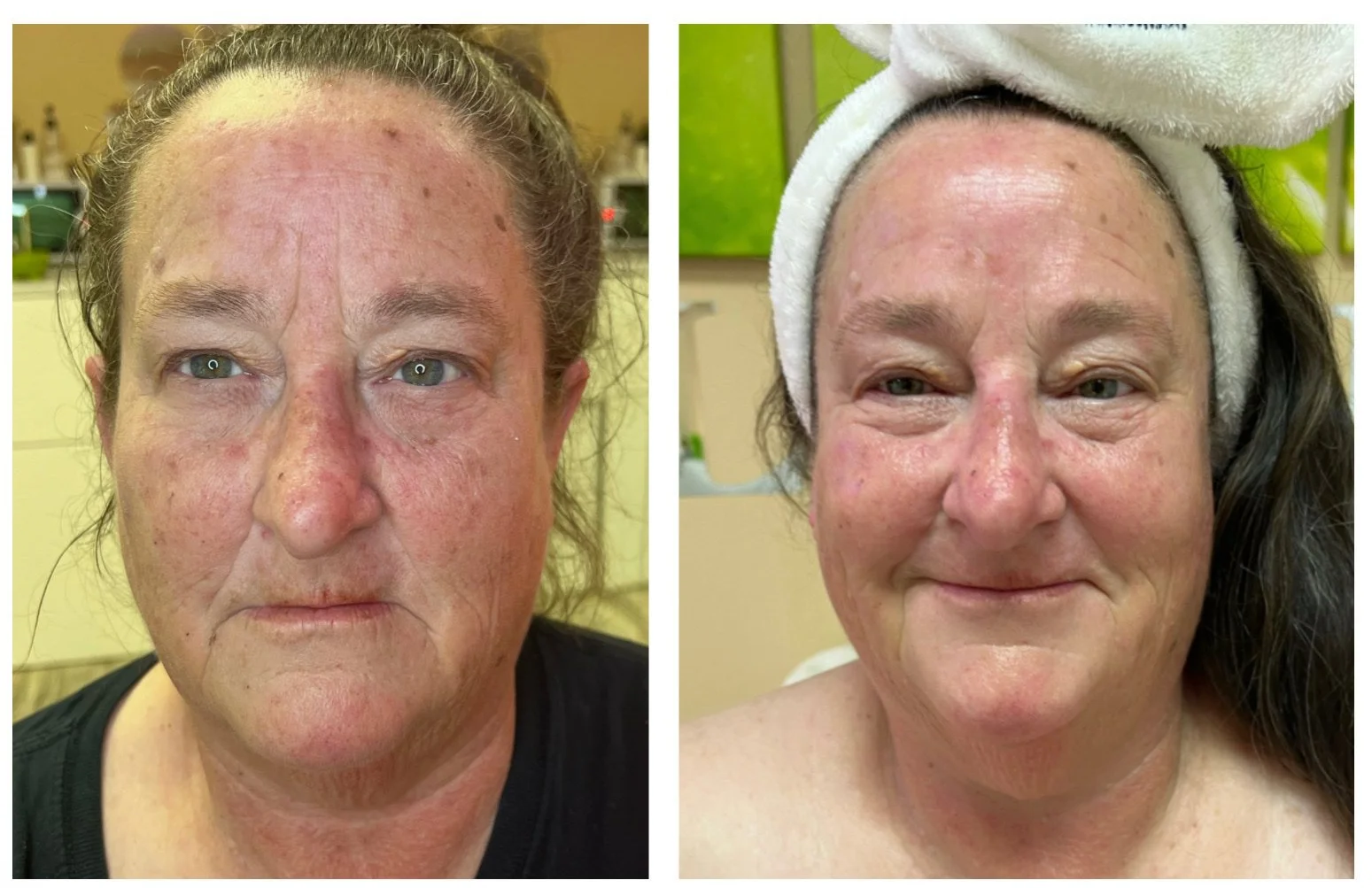 Side-by-side comparison of a woman's face showing skin improvement, with redness and blemishes on the left and clearer skin on the right.