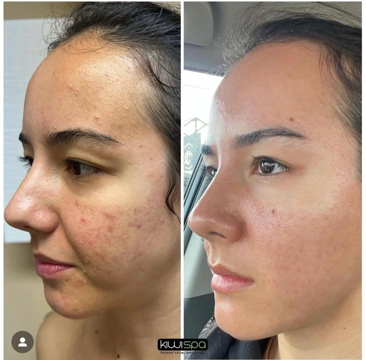 What Triggers Acne? Let’s Talk About the Real Reasons