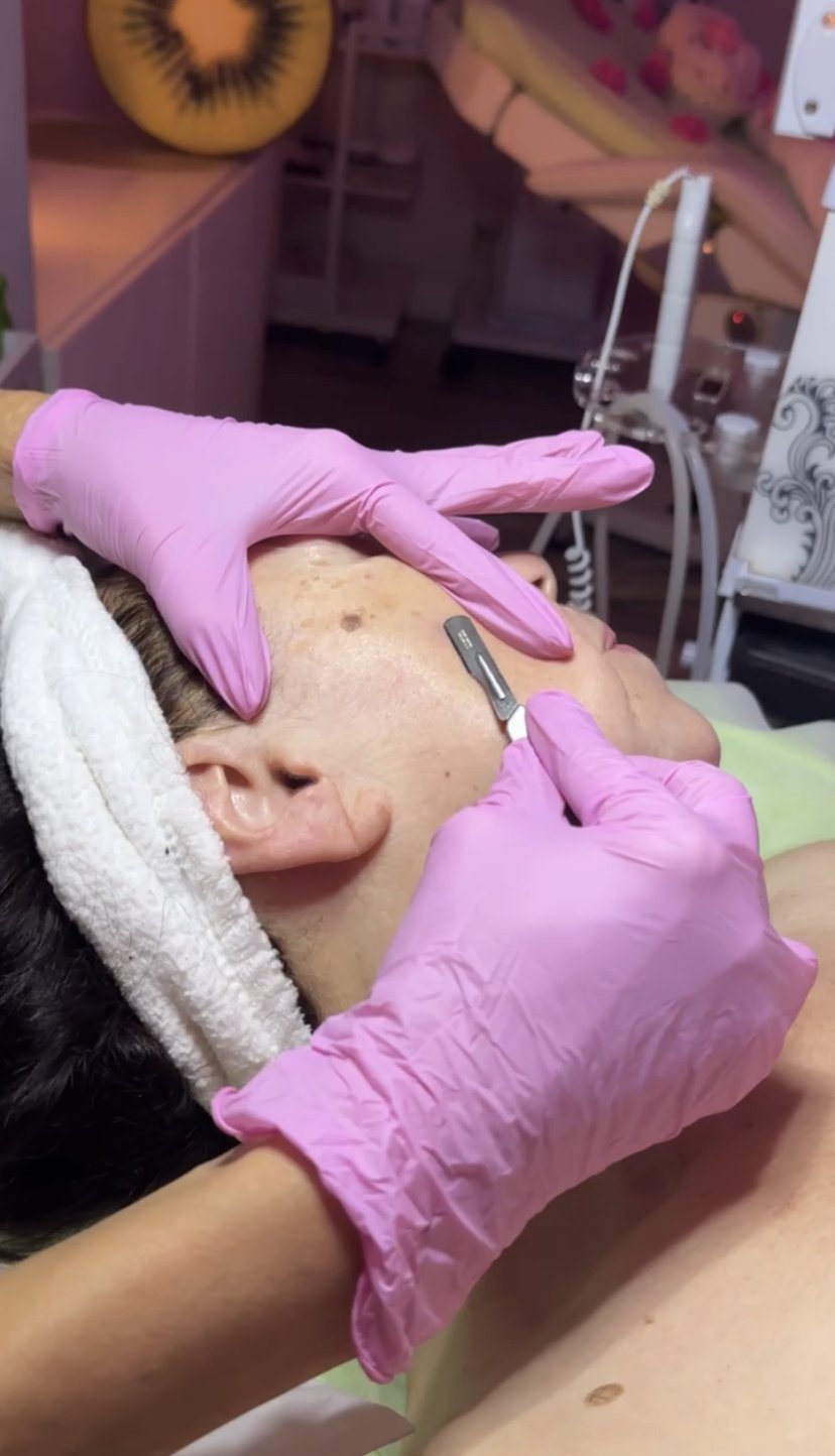 How Does Dermaplaning Help Your Skin?