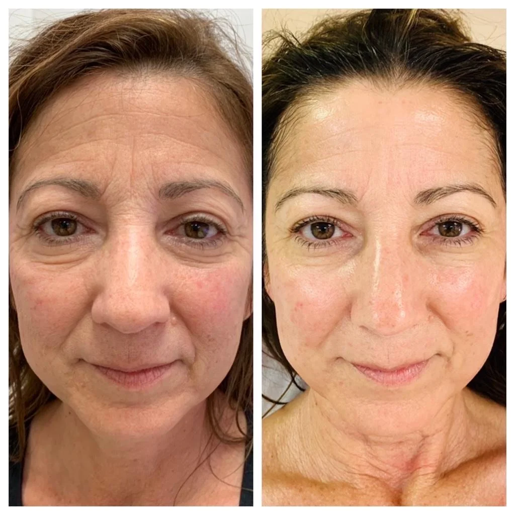 Are You Looking for an Anti-Aging Facial in San Diego Before Christmas?