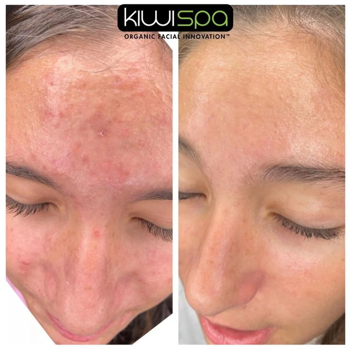 How to Avoid Acne in San Diego: A Clear-Skin Routine That Supports Your Skin Barrier