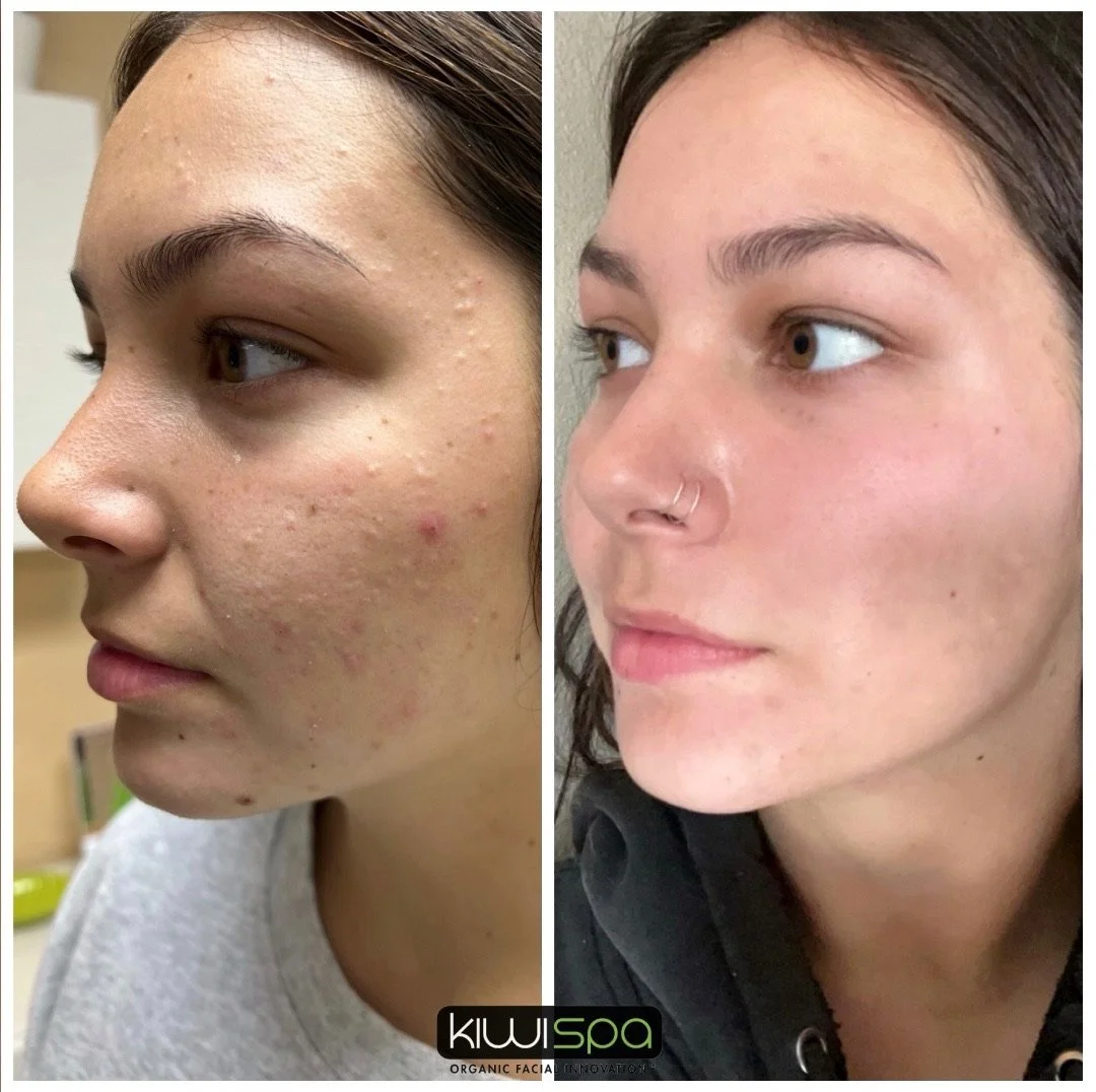 What Causes Blackheads and How Kiwi Spa Helps Clear Them