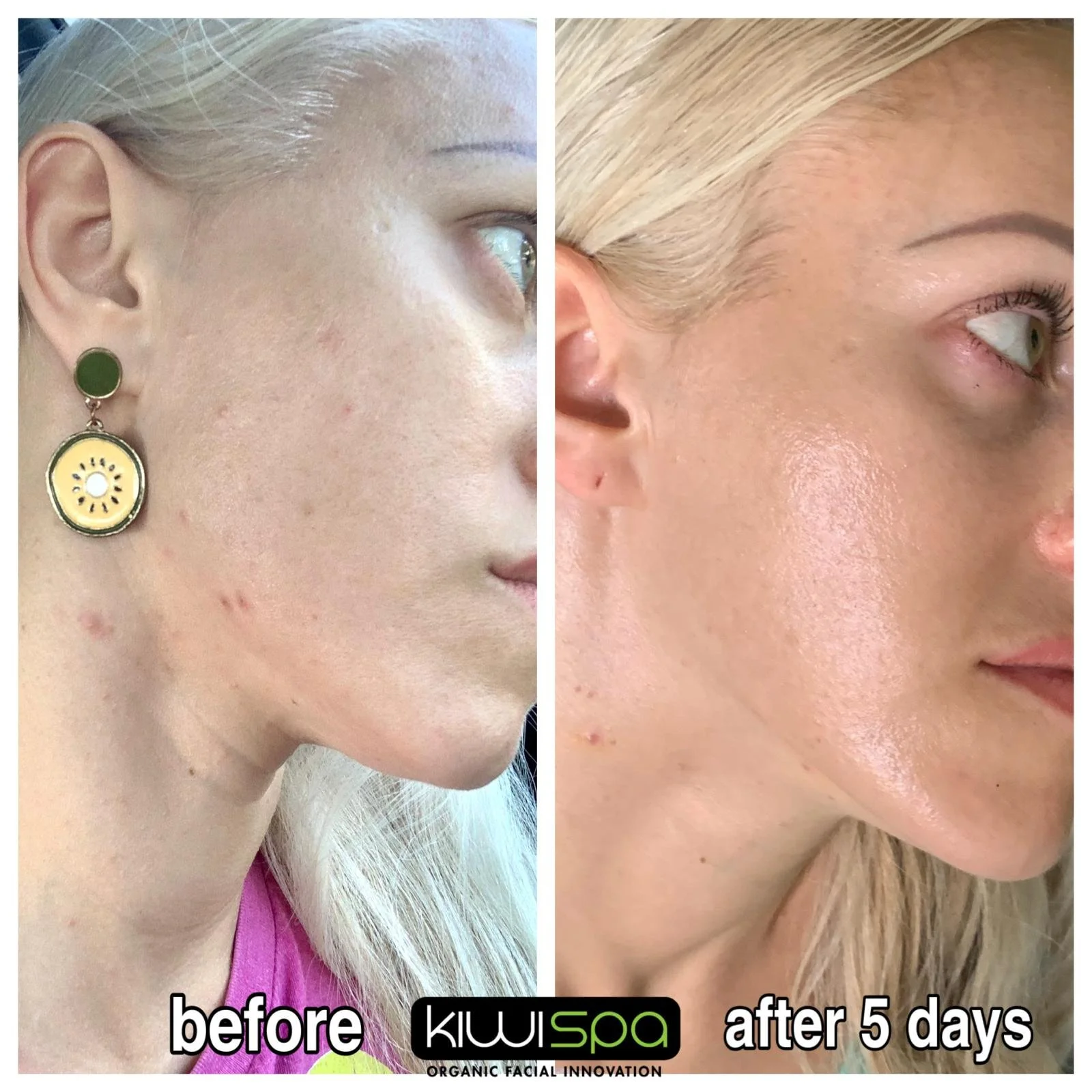 Chemical Peels in San Diego: What They Treat and Why So Many People Search for Them