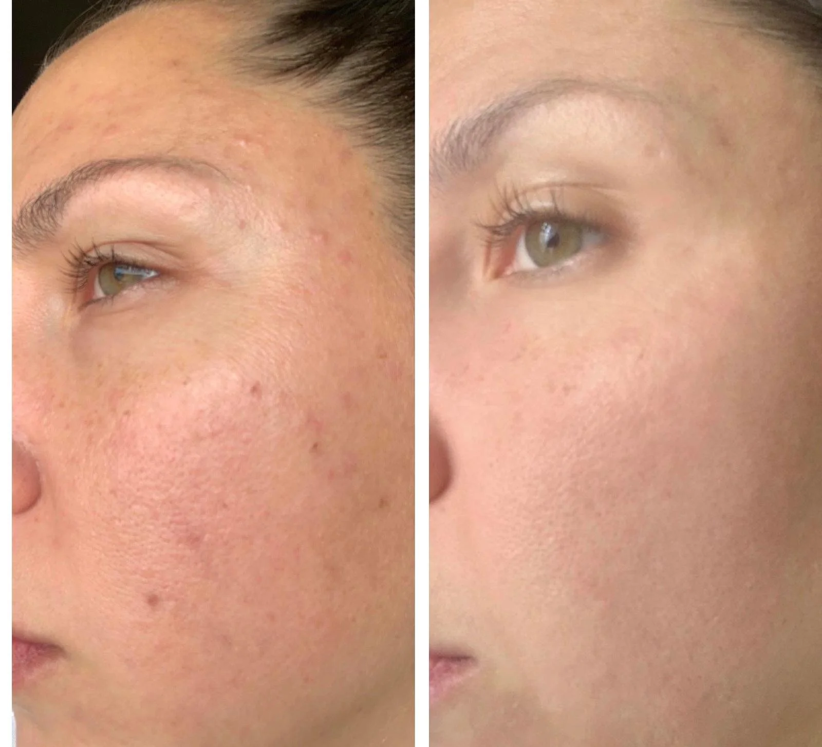 Are You Struggling With Acne and Not Sure What to Do?