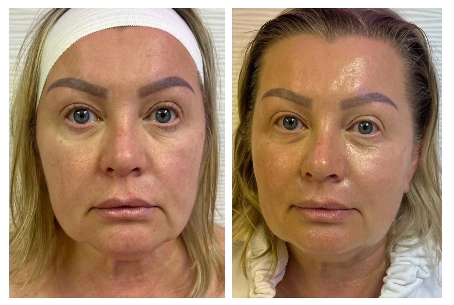 Why Does My Skin Feel So Dry? How a Hydrating Facial Helps