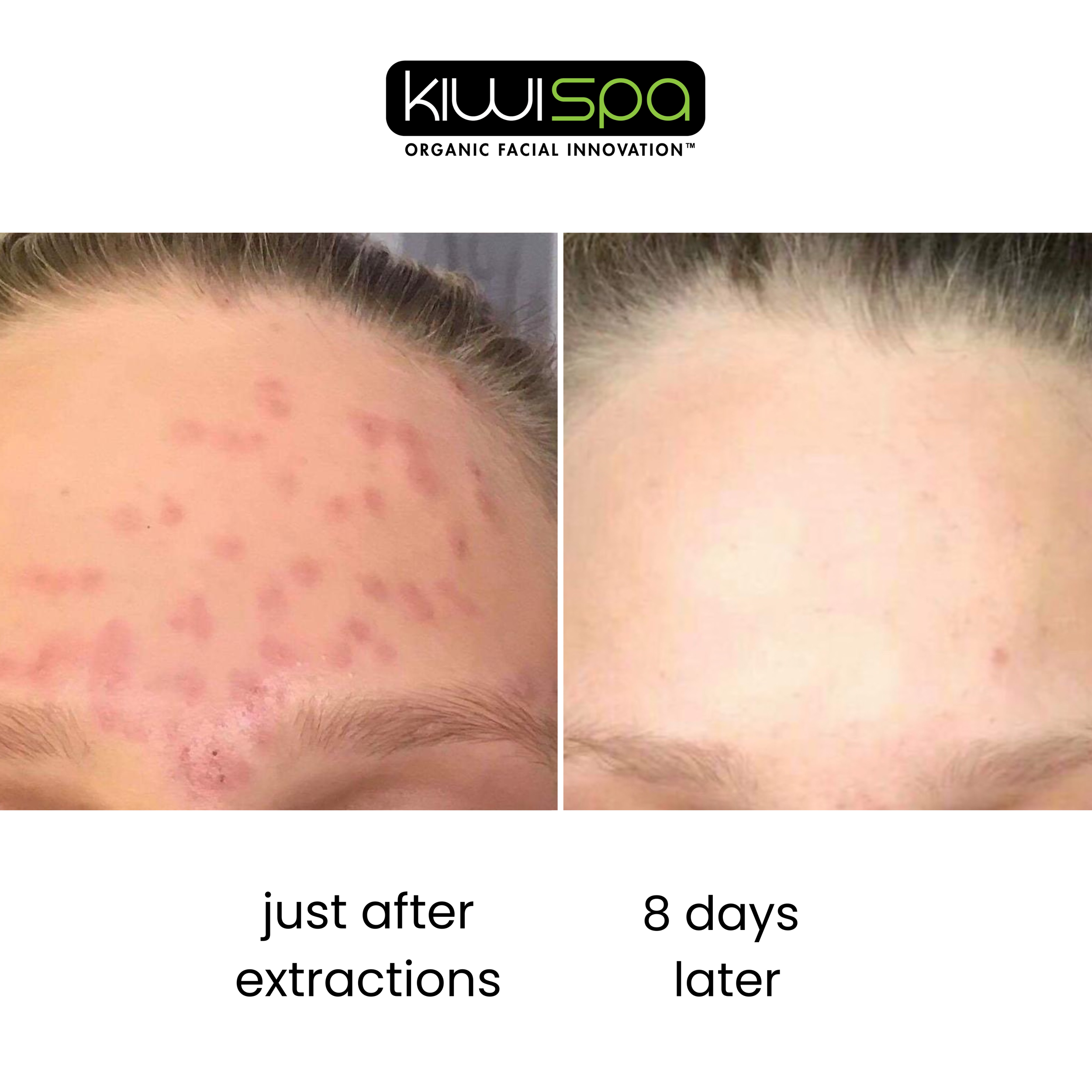 How Do My Skin Looks Like After Extractions?