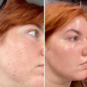 Facial for Sensitive Skin San Diego: Gentle Care for Calm, Balanced, Happy Skin