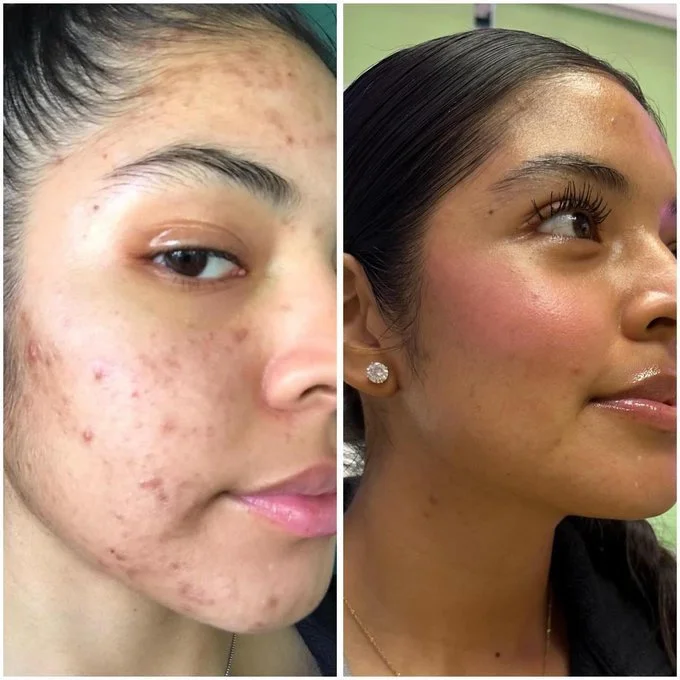 Acne Facial San Diego for Clearer, Smoother, Healthier-Looking Skin
