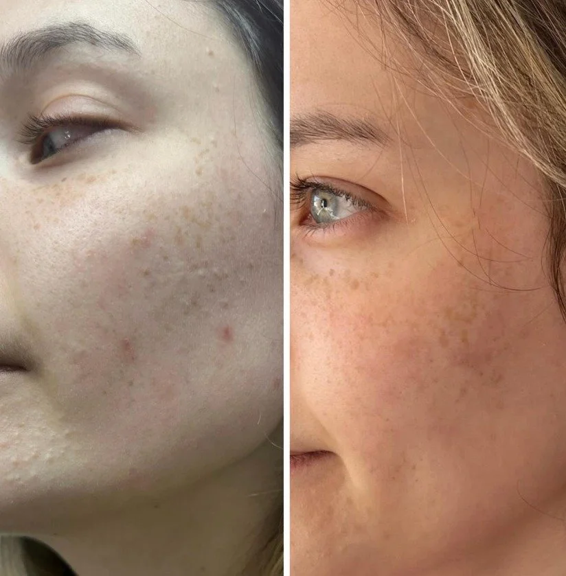 Facial for Sensitive Skin San Diego: A Gentle Way to Calm and Glow