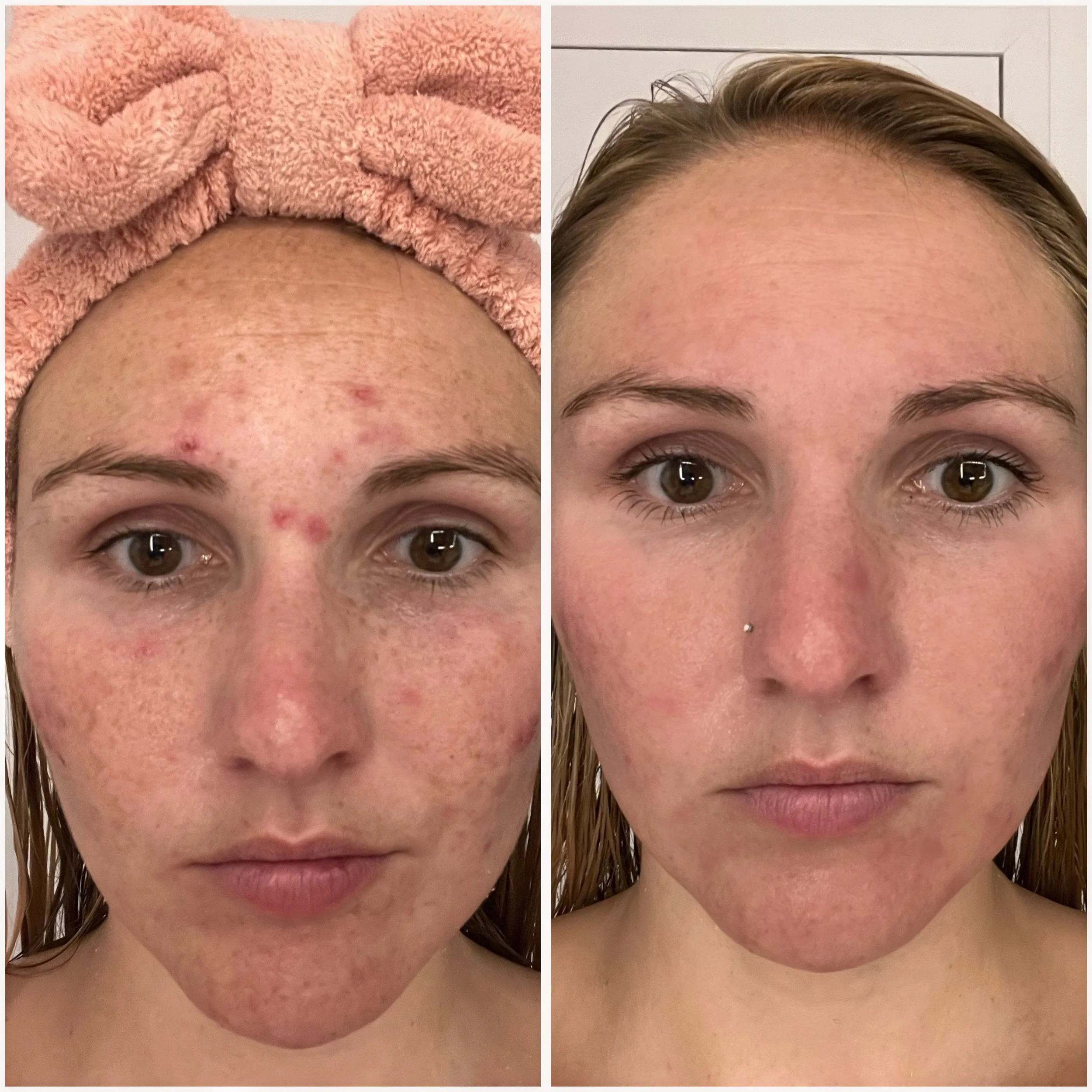 What Causes Acne and How Kiwi Spa Helps Treat It: Your Clear Skin Guide