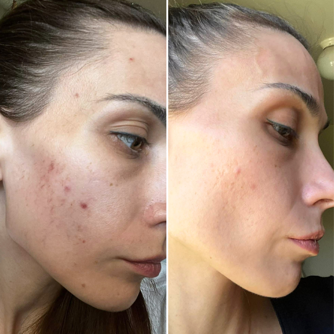 Clear Skin Starts Here: Best Acne Facials Near Ocean Beach San Diego 