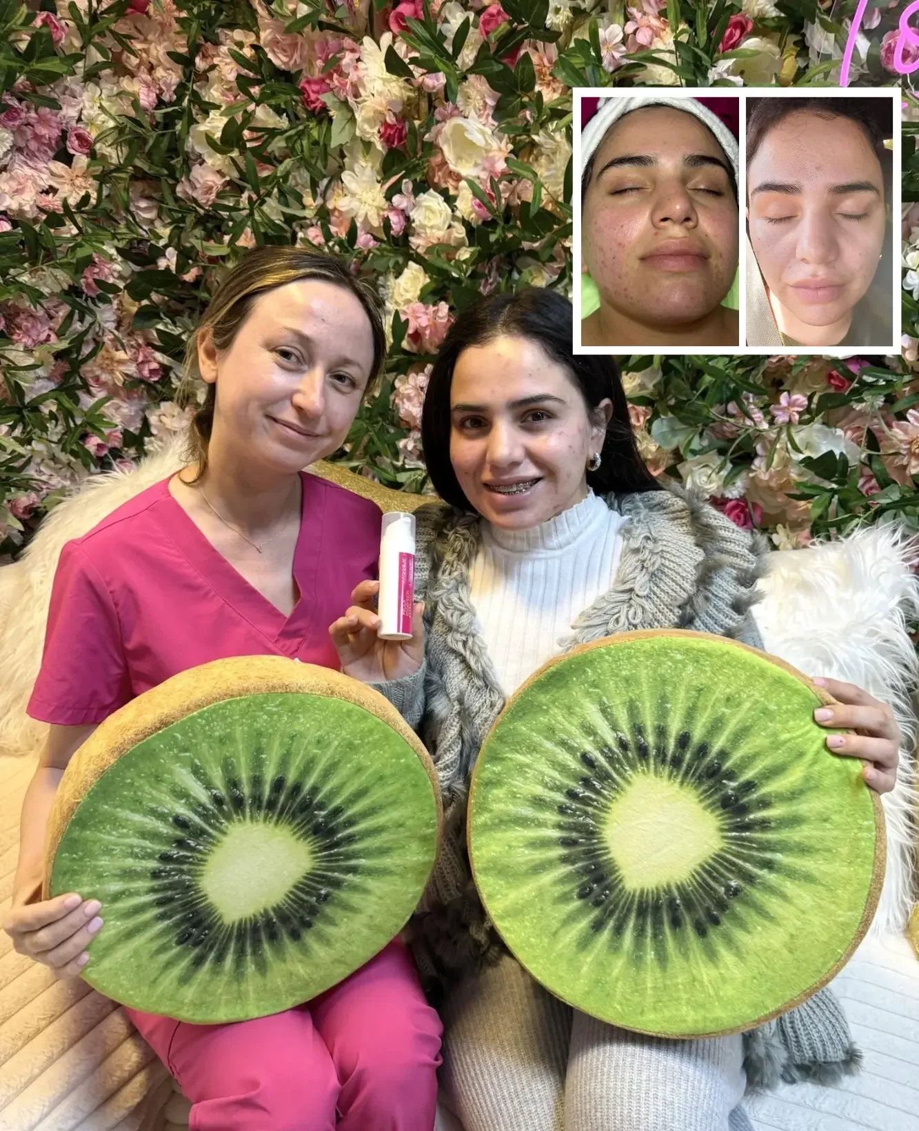 Acne Facial in San Diego for Clearer, Smoother, More Confident Skin