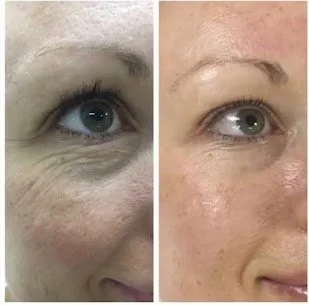 Anti-Aging Facial in San Diego for a Fresh, Smooth, Radiant Glow