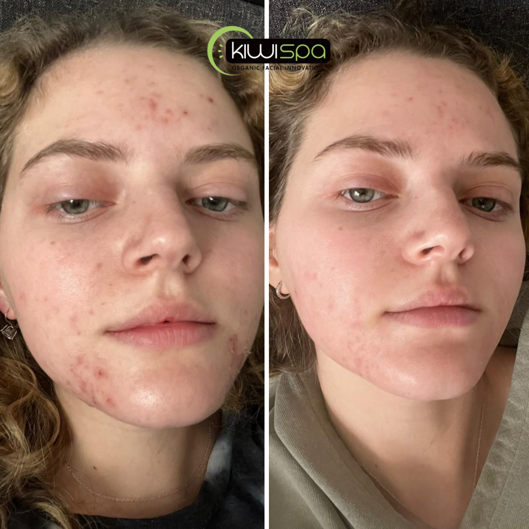 Acne Facial San Diego for Clearer, Smoother Skin at Kiwi Spa