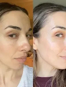 Hydra Facial San Diego Alternative for Deep Hydration and Glow