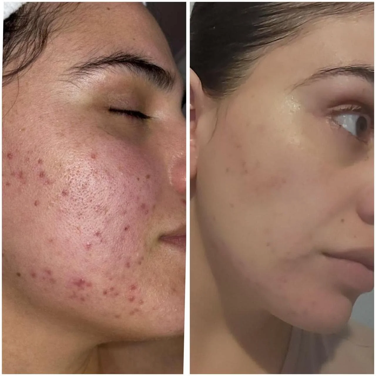 Are You Looking for an Acne Facial in San Diego?