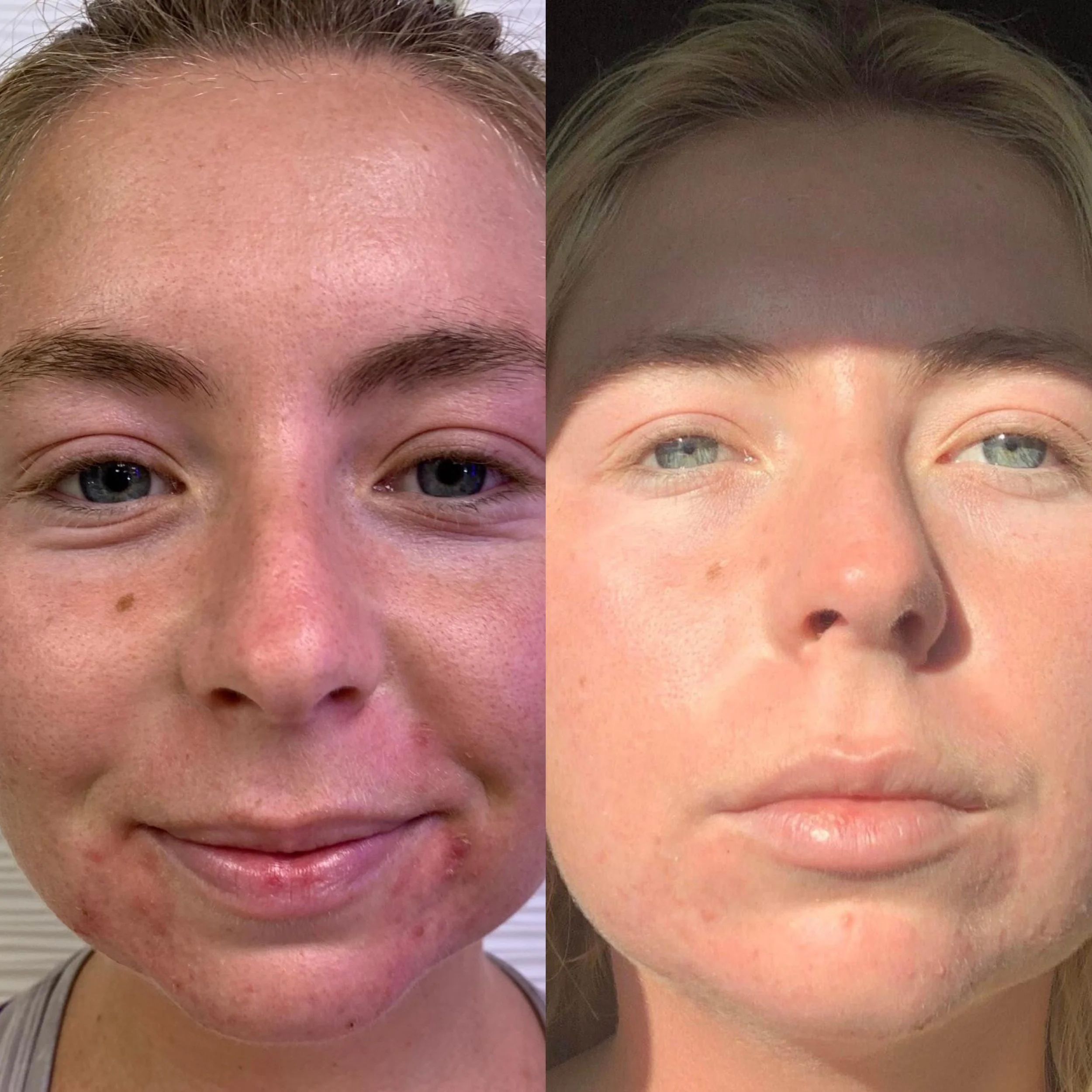 What Causes Acne and Why Does It Keep Coming Back?