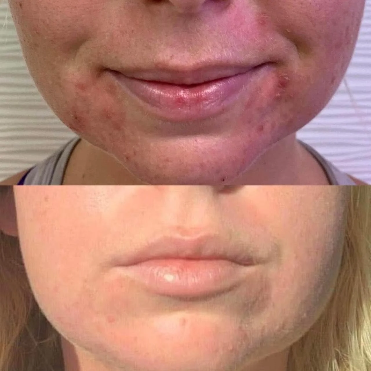 Are You Looking for Rosacea Treatment in San Diego?
