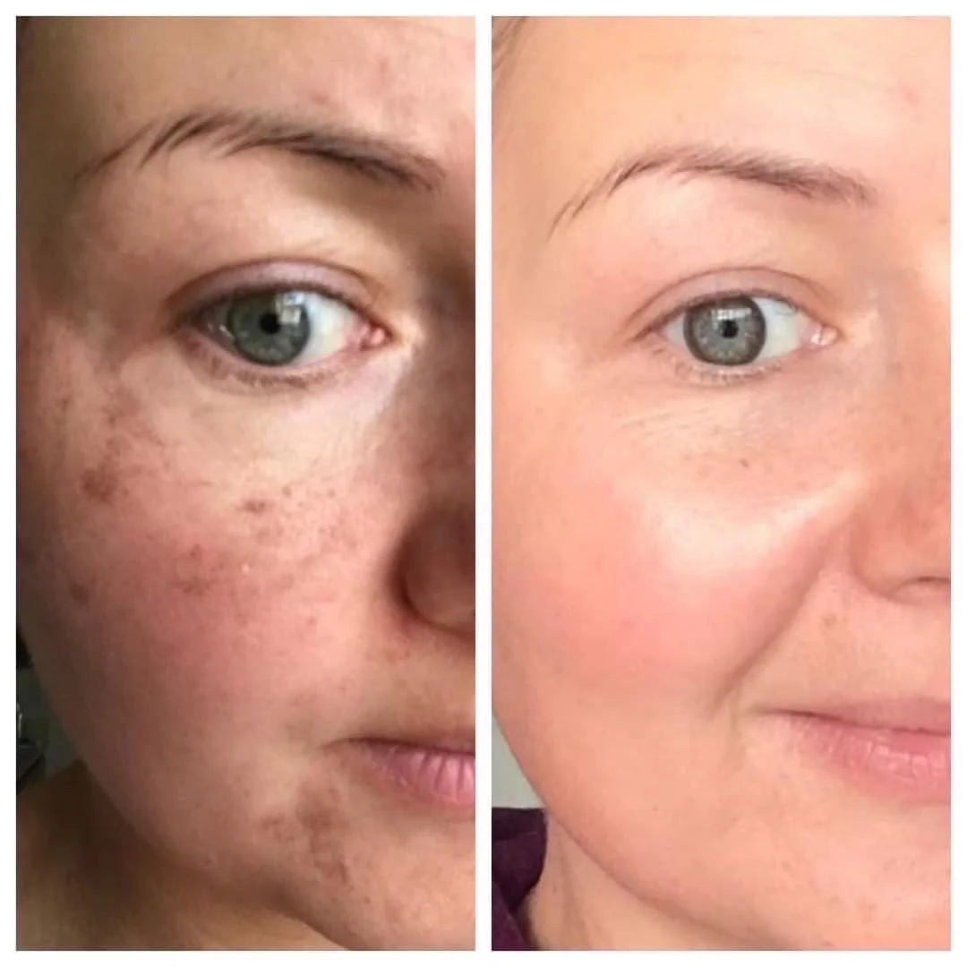 Why Does a Chemical Peel Help With Pigmentation?