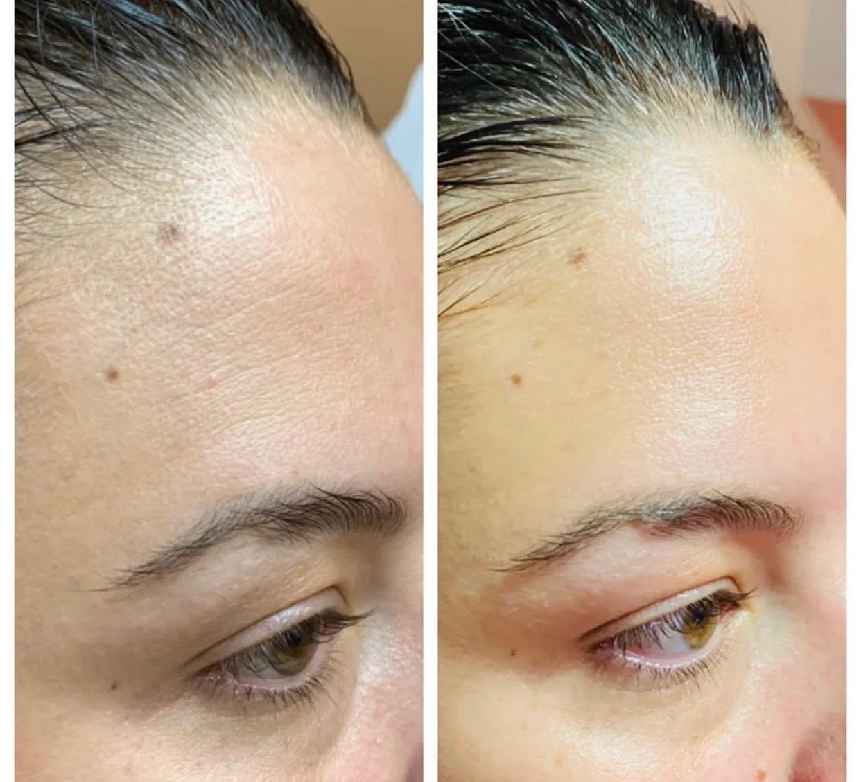 Hydrating Facial in San Diego: Is Your Skin Trying to Tell You Something?