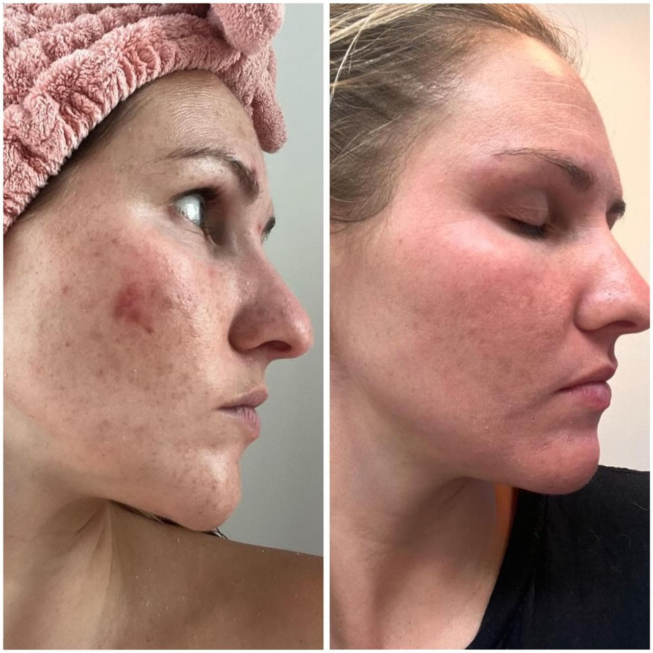 Acne Facial San Diego: Clearer, Healthier Skin at Kiwi Spa
