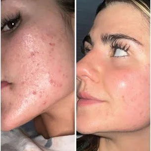 Looking for an Acne Facial in San Diego? Discover a Supportive Skin Reset at Kiwi Spa
