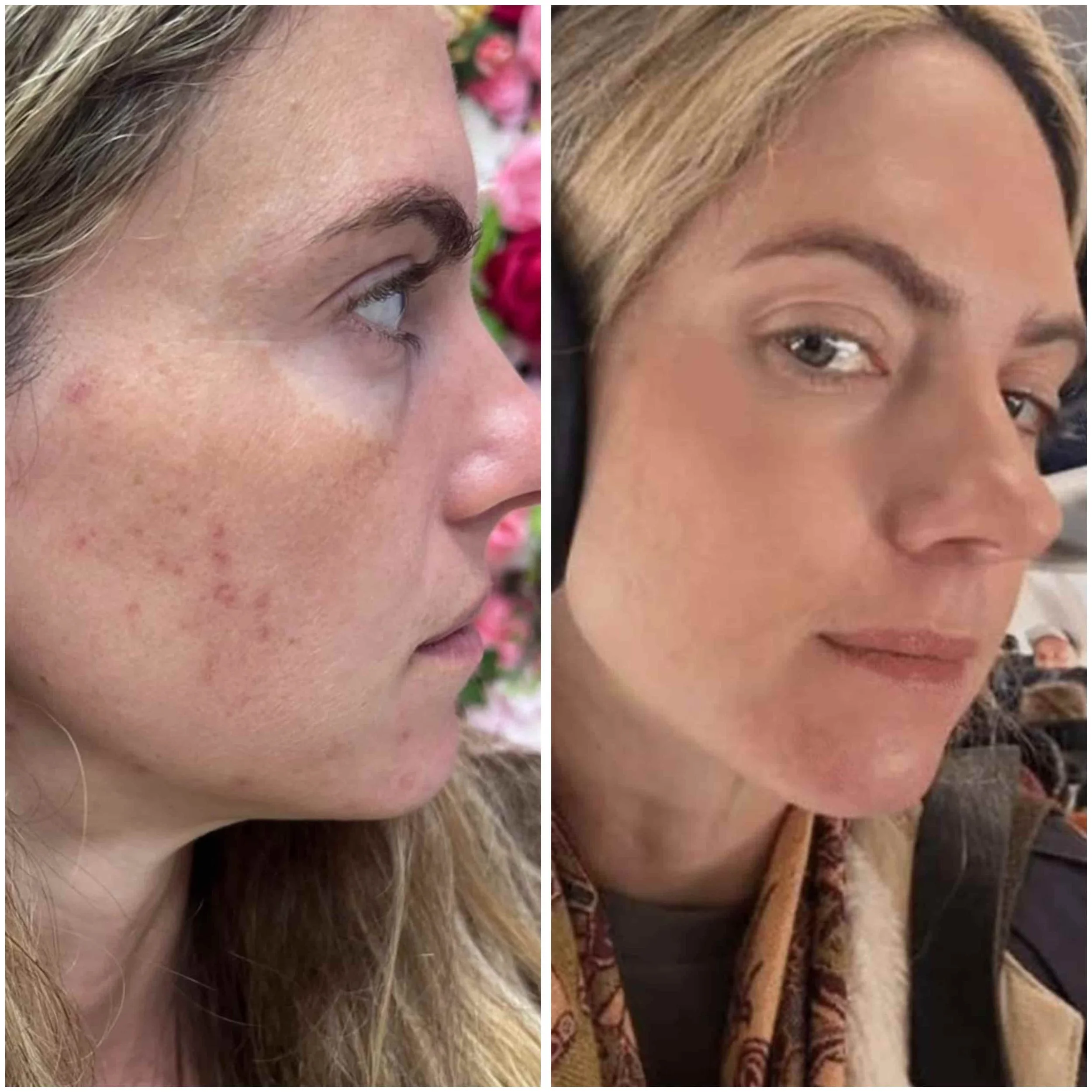 Pigmentation Treatment in San Diego: Christina's 6-Month Skin Transformation Journey