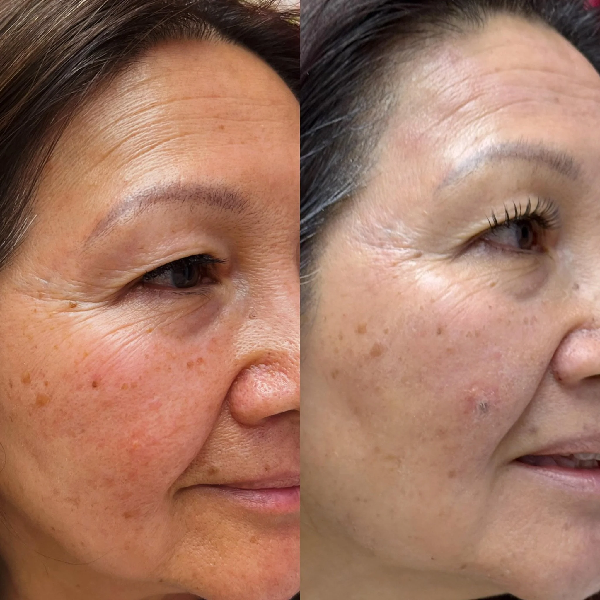 Pigmentation Treatment in San Diego: Why Dark Spots Appear and What You Can Do About Them