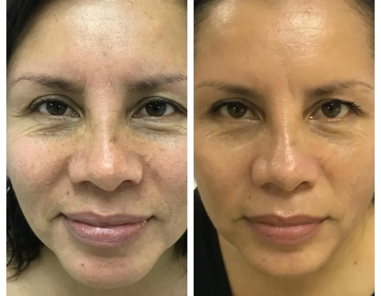 The Truth About Human Placenta Facials: Are They Worth It?