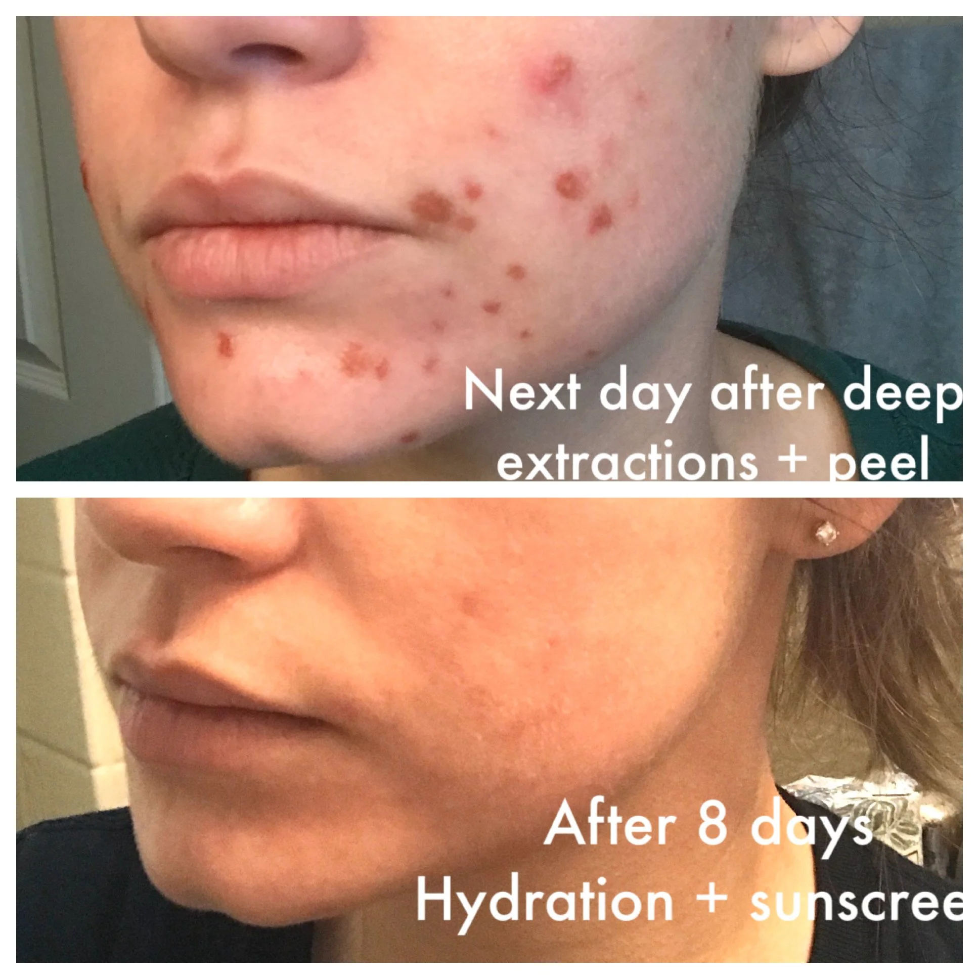 Why Do We Need Facial Extractions? The Secret to Clear, Healthy Skin
