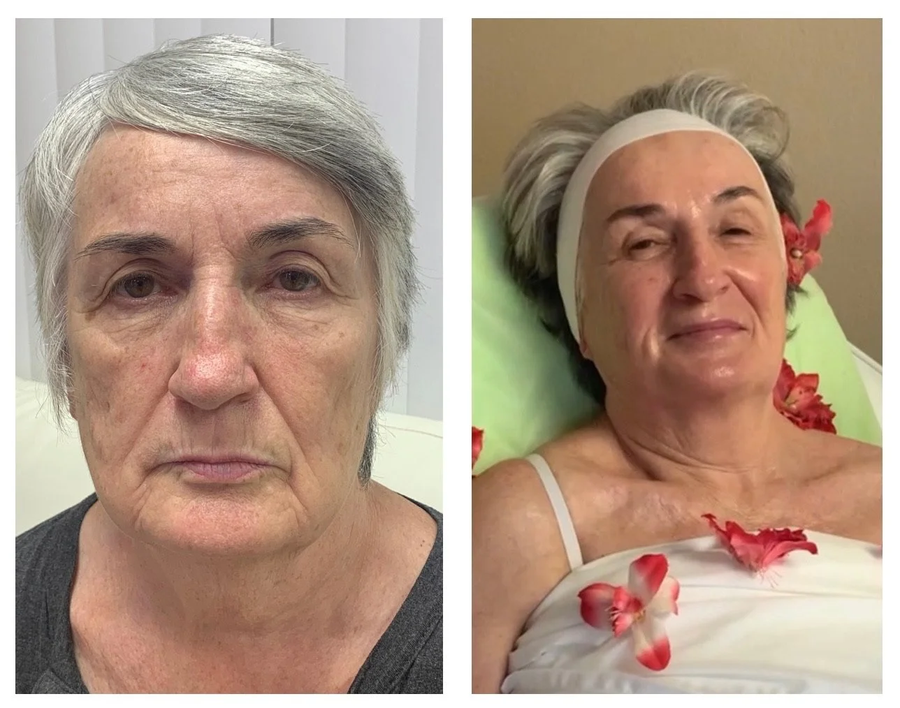 Side-by-side comparison of a woman's face showing skin improvement, with redness and blemishes on the left and clearer skin on the right.